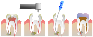500px-Root_Canal_Illustration_Molar.svg