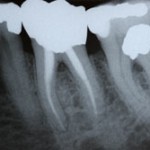 root_canal_after_xray_case1